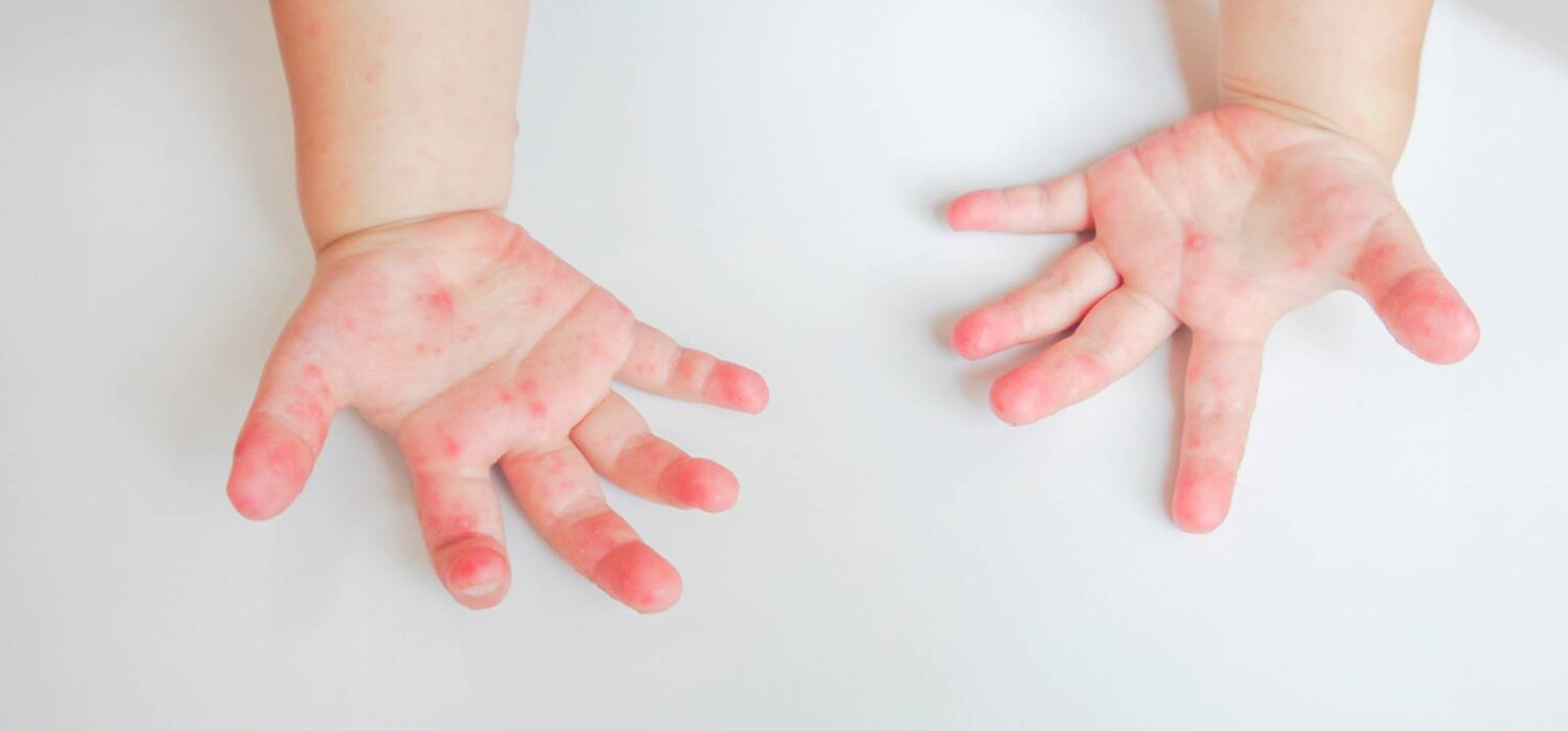 virus Coxsackie en ninos