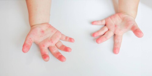 ¿Qué es el virus Coxsackie?