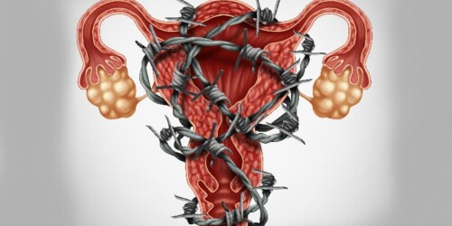 ¿Qué es la endometriosis?