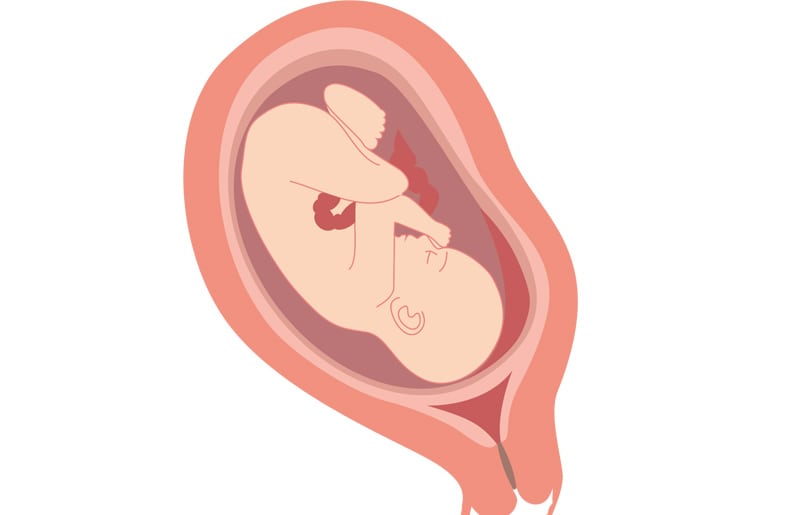 ¿Qué es la placenta previa?