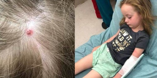 Garrapata causa parálisis a una niña de 5 años