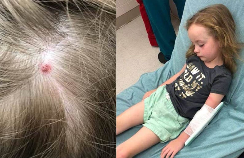 Garrapata causa parálisis a una niña de 5 años