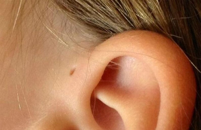 ¿Por qué tu hijo tiene hoyitos en las orejas?