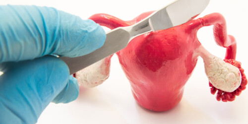 Salpingoclasia: tipos, costos y beneficios