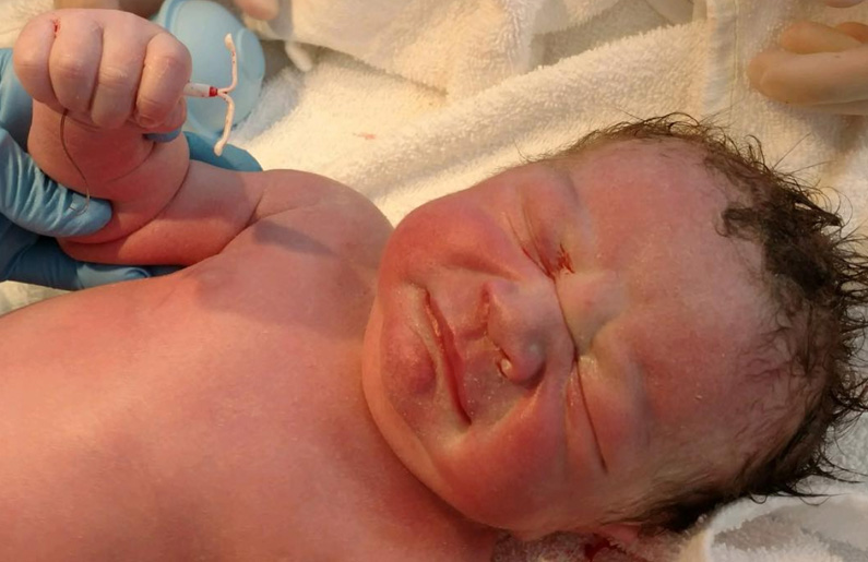 El bebé que nació con el DIU de su madre en la mano