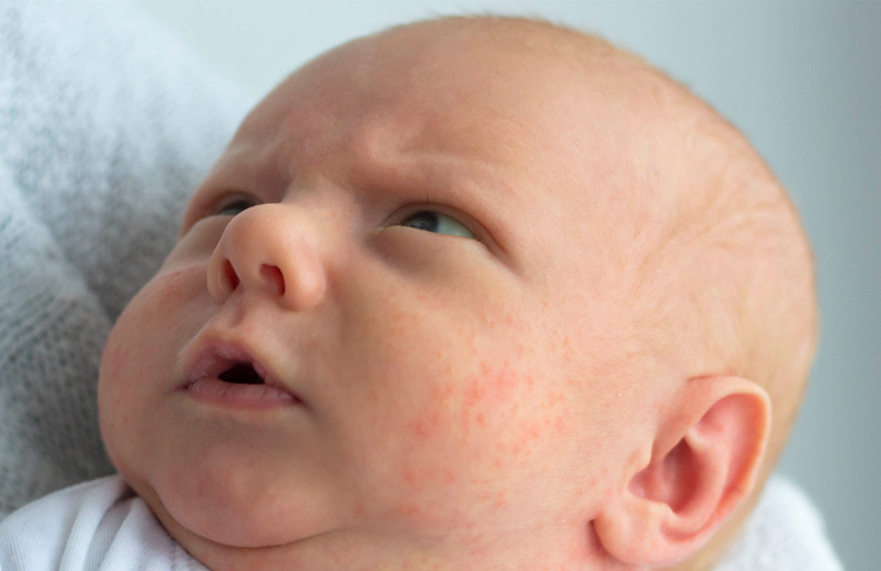 ¿Qué es la miliaria en recién nacidos?
