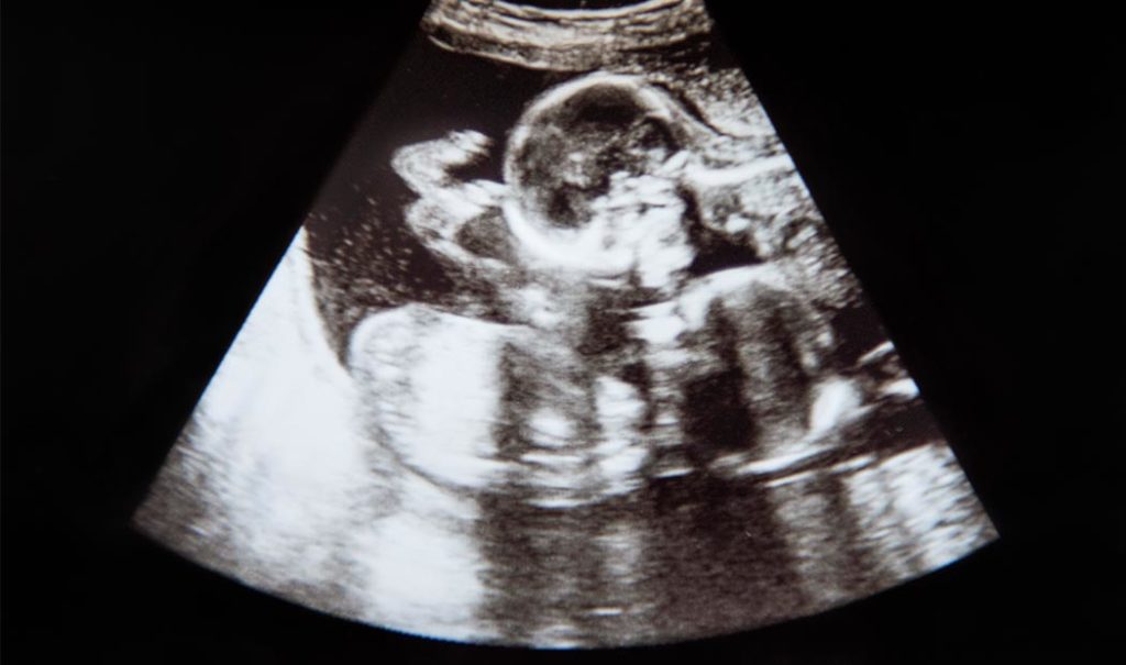 ¿Qué son los gemelos parásito (fetus in feto)?