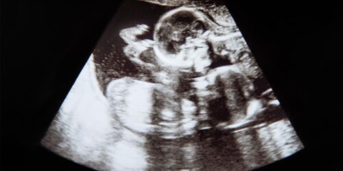 ¿Qué son los gemelos parásito (fetus in feto)?