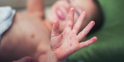 Por epidemia de sarampión, Nueva York declara emergencia sanitaria