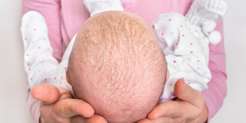 Alopecia infantil: tipos y causas