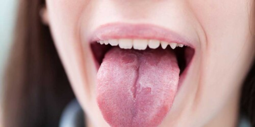 ¿Tu hijo tiene lengua geográfica?