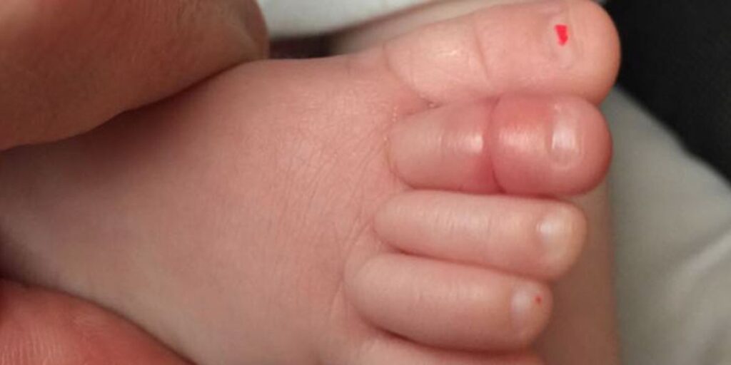 Síndrome del torniquete: riesgo de amputación de los dedos del bebé