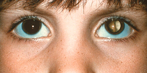 Cáncer ocular en niños: ¿Cómo saber si mi hijo tiene retinoblastoma?