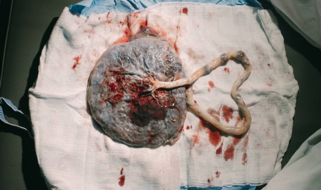 mujer se cura de vih por trasplante de celulas madre de cordón umbilical