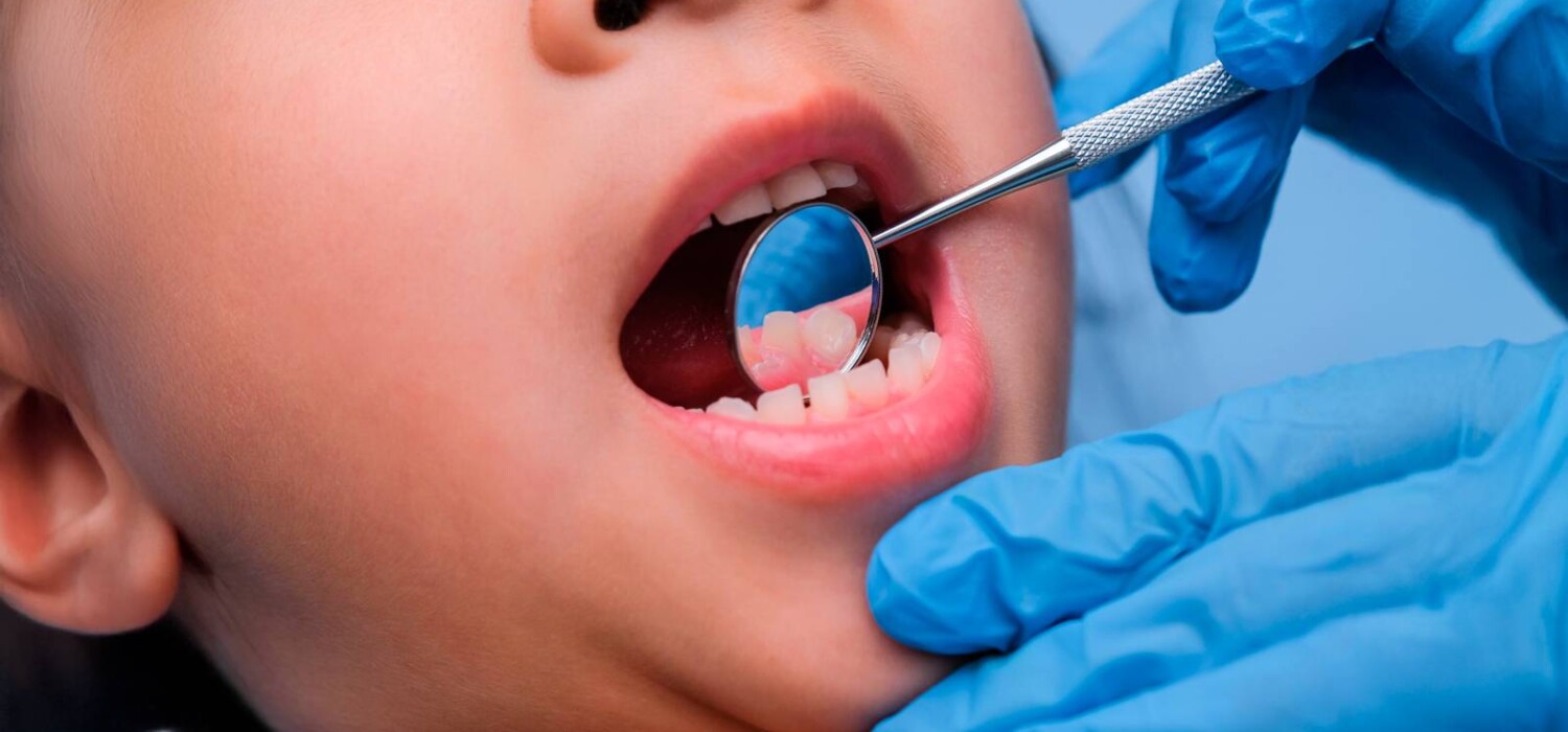torus mandibular
