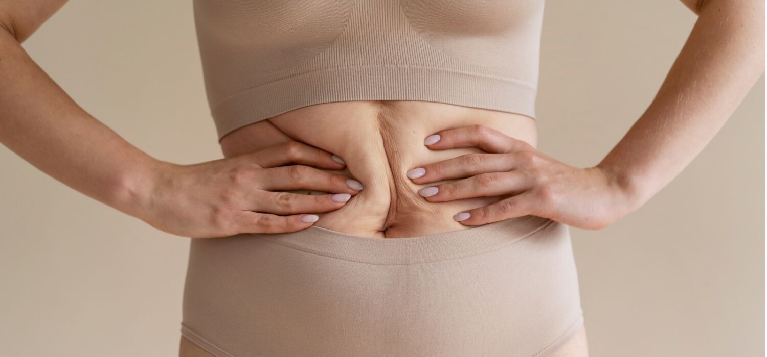 diastasis abdominal