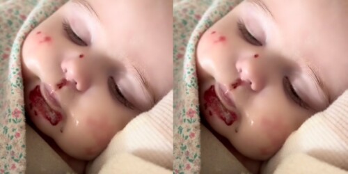 Fallece bebé de 10 meses por ‘piel de mariposa’. Conoce de qué se trata