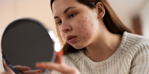 Acné en adolescentes: Tips para evitarlo