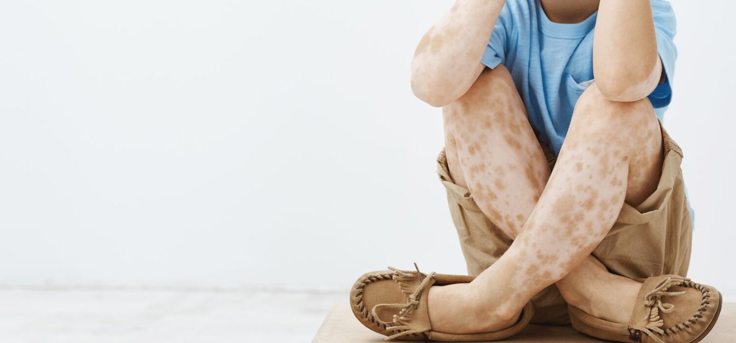 Vitiligo infantil, lo que tienes que saber