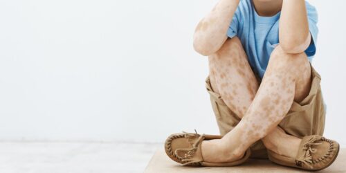 Vitiligo infantil: lo que tienes que saber