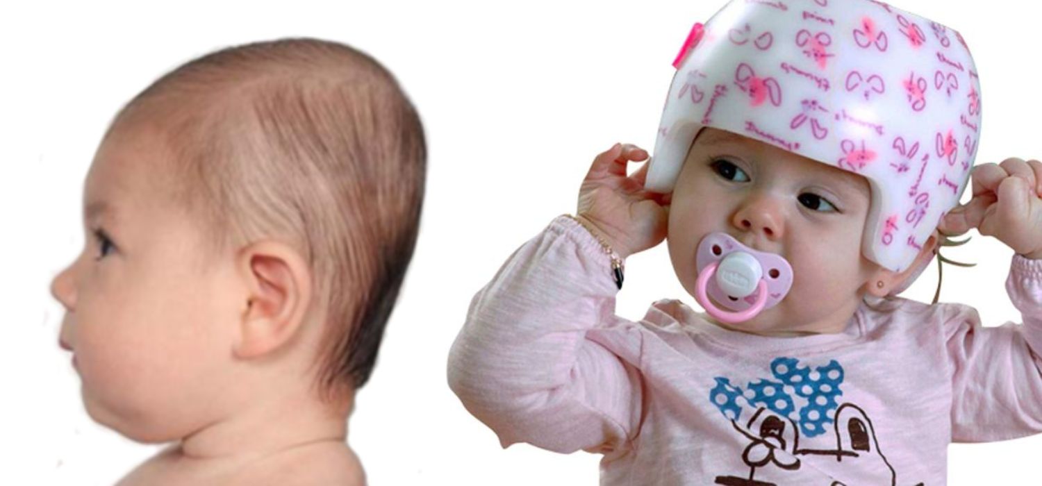 cómo evitar cabeza aplanada en bebés