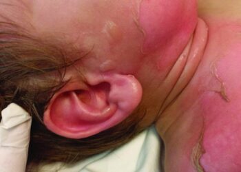 5 acciones para prevenir quemaduras en la infancia