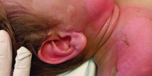5 acciones para prevenir quemaduras en la infancia