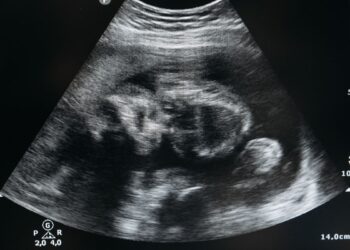 ¿Te puedes embarazar estando embarazada?: es superfetación
