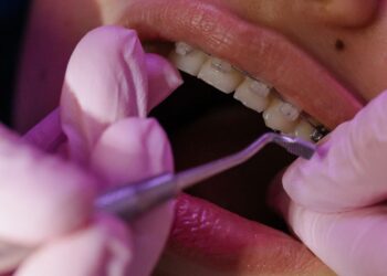 ¿Por qué algunos niños necesitan brackets y otros no?