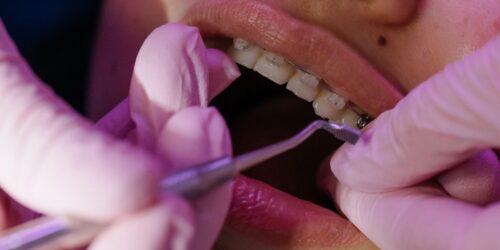 ¿Por qué algunos niños necesitan brackets y otros no?