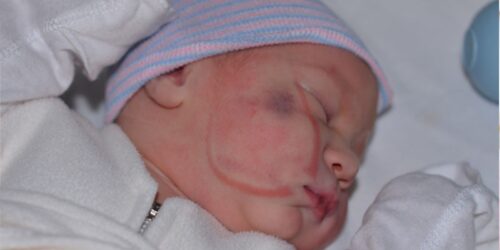 Uso de fórceps en el parto: cuándo se usa y qué riesgos tiene