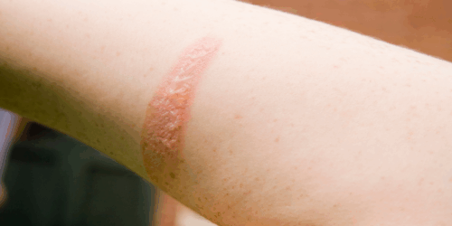 Jazlyn Azuleth sobrevivió tras la explosión de la pipa