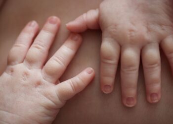 Muere niño de 1 año por sarampión en Tlaxcala: no tenía vacuna