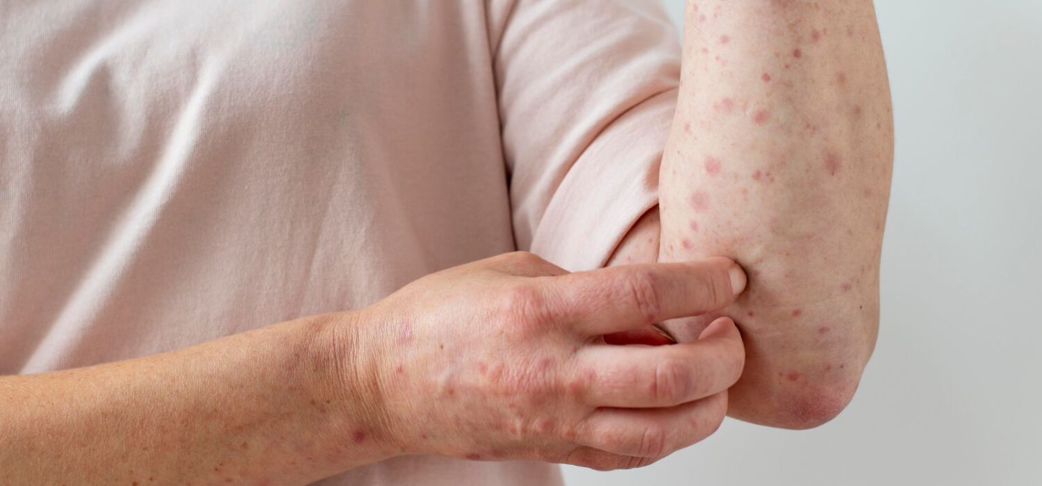 españa no es libre de sarampión