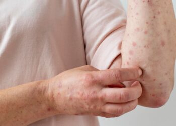 España ya no es un país libre se sarampión… ¿por qué esto importa?