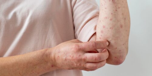 España ya no es un país libre se sarampión… ¿por qué esto importa?