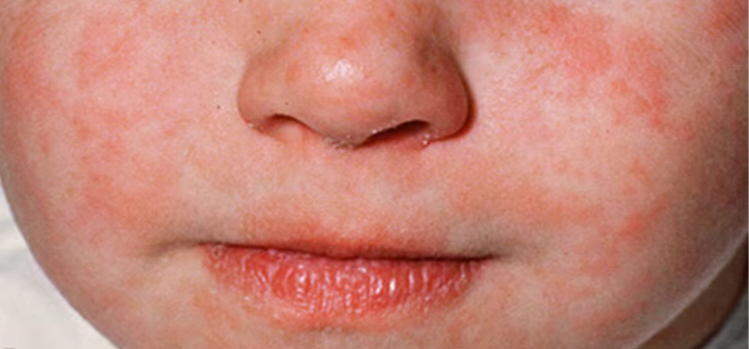 niños cuidados sarampion