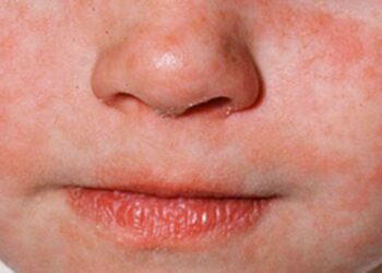 5 claves para proteger a los bebés del sarampión en México