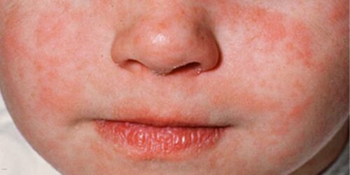 5 claves para proteger a los bebés del sarampión en México