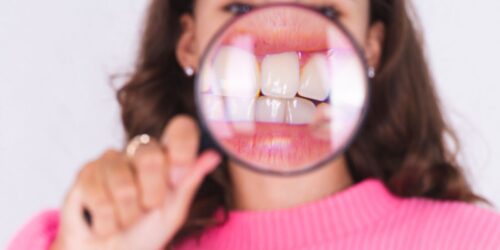 ¿Sabes qué es la malaoclusión? ¡Prevén los dientes chuecos!