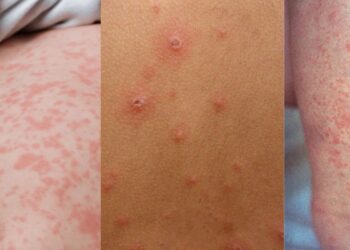 Sarampión, varicela y rubéola: cómo distinguir el sarpullido sin entrar en pánico