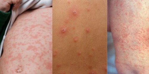 Sarampión, varicela y rubéola: cómo distinguir el sarpullido sin entrar en pánico