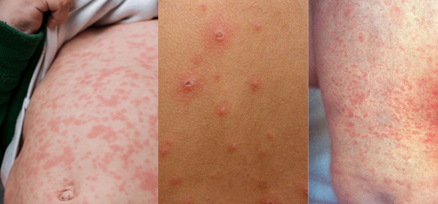 sarmapion rubeola y varicela