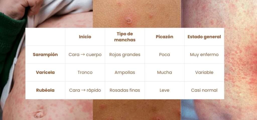 diferencias sarampion y varicela