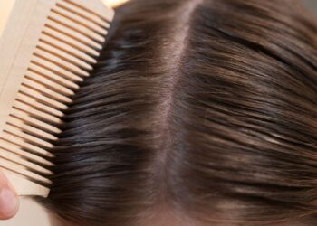 ¿Se puede prevenir la pérdida de pelo en el posparto?