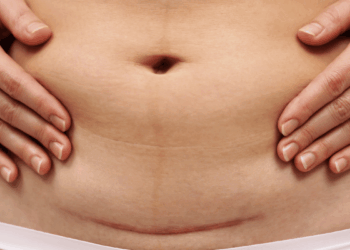 Las cesáreas en México ya representan el 55% de los nacimientos