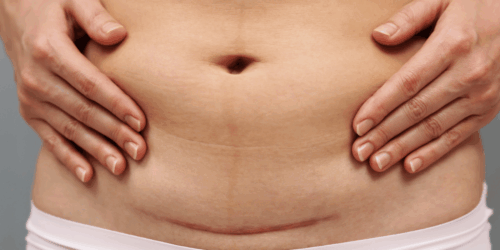 Las cesáreas en México ya representan el 55% de los nacimientos