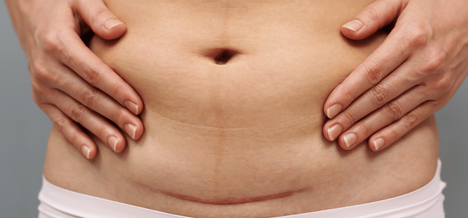 Cesáreas en México