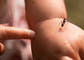 Picadura de insectos en la playa: qué hacer y cuándo preocuparse