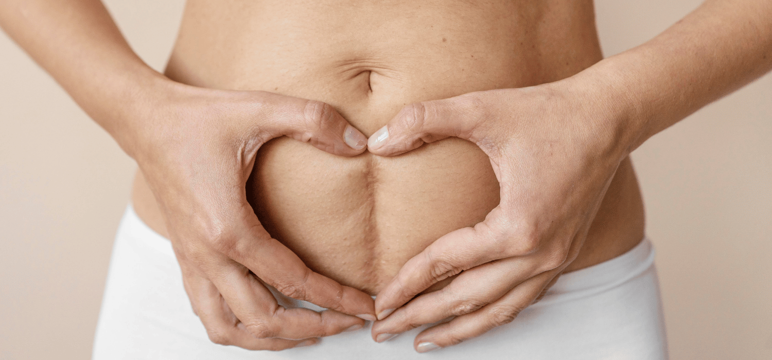 6 recomendaciones para recuperarte después de una cesárea